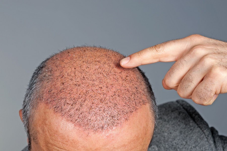 Biến chứng có thể xảy ra sau khi cấy tóc FUE - Vật lý trị liệu