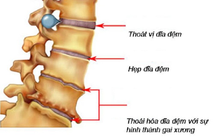 Thoái hóa cột sống lưng là một bệnh lý khá phổ biến hiện nay