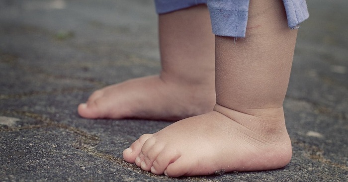 Hầu hết bàn chân bẹt ở trẻ em dưới 3 tuổi đều là hiện tượng sinh lý bình thường