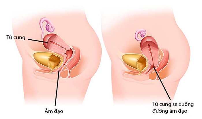 Sa tử cung là hiện tượng tử cung bị giãn quá mức sa xuống dưới âm đạo hoặc ra ngoài cơ thể
