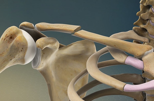 Hình ảnh giải phẫu gãy xương đòn