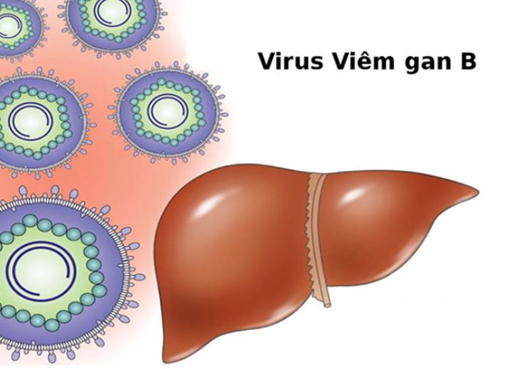 Viêm gan B là một bệnh lý tại gan do virus HBV gây ra