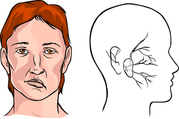Bấm huyệt Nhân Trung giúp điều trị bệnh méo miệng và liệt dây thần kinh số 7