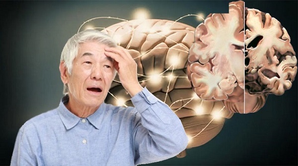 Hỗ trợ điều trị Alzheimer hiệu quả