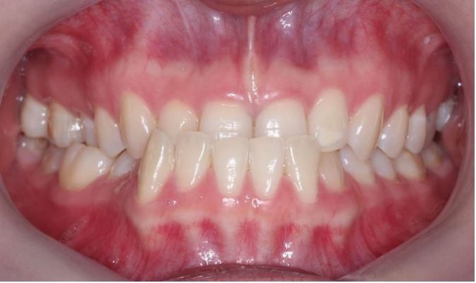Răng hàm dưới chìa ra nhiều hơn răng hàm trên 