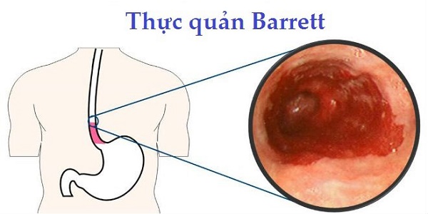 Biến chứng hội chứng thực quản Barret là một biến chứng nguy hiểm, tiềm ẩn nguy cơ ung thư cao