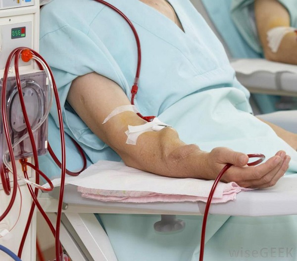 Quy trình chạy thận nhân tạo sẽ gồm hai bước là đặt nơi truy cập mạch máu và lọc máu
