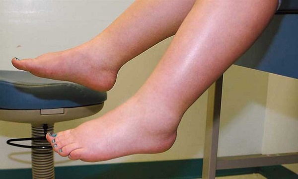 Người bệnh suy thận thường có biểu hiện phù ở mắt cà chân và bàn chân