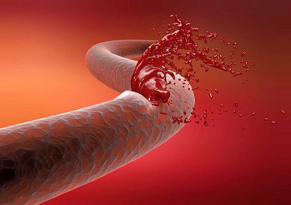 Khi các mạch máu tại dạ dày bị tổn thương do nhiều nguyên nhân khác nhau dẫn đến xuất huyết