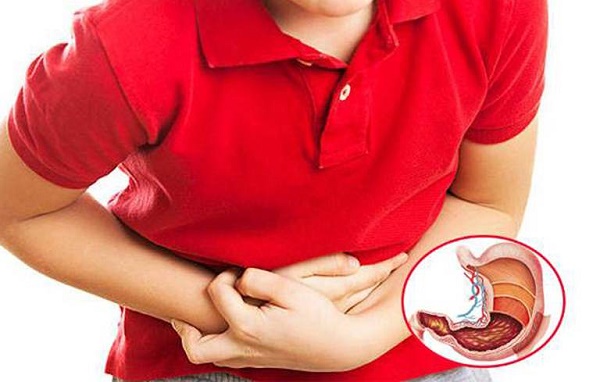 Viêm dạ dày được chia thành hai loại là viêm dạ dày cấp và viêm dạ dày mạn