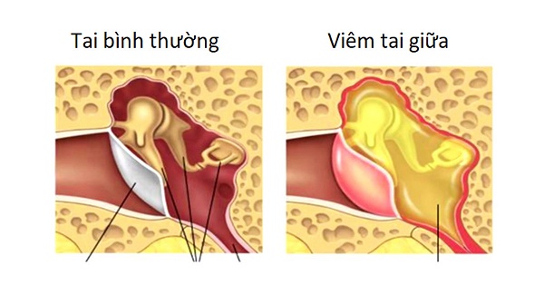 Dịch viêm xoang có thể di chuyển lên tai gây ra viêm tai giữa là một biến chứng thường gặp của bệnh lý này