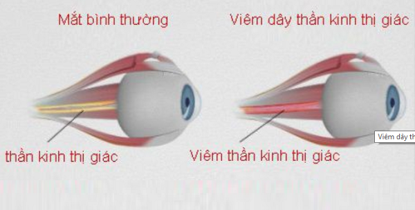 Biến chứng tại mắt do viêm xoang thường là viêm dây thần kinh thị giác, abces mu mắt, abces túi lệ, viêm mô liên kết xung quanh hốc mắt.