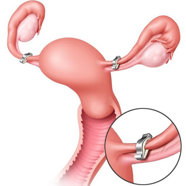 Phẫu thuật thắt ống dẫn trứng là một phương pháp triệt sản ở phụ nữ